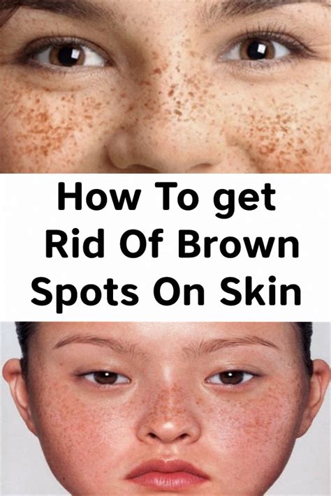 Causes Of Brown Discoloration Of Facial Skin Heidi Salon