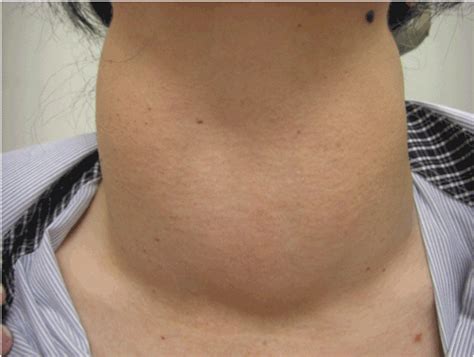 Swollen Neck Thyroid
