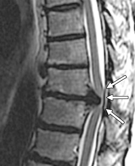 Nontraumatic Spinal Cord Compression Mri Primer For Emergency