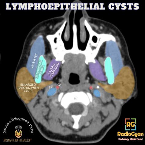 Benign Lymphoepithelial Cysts Of The Parotid Gland Radiology Case