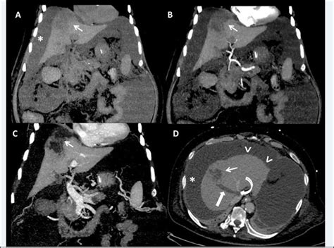Contrast Ct Scan Confirmed Liver Cirrhosis Gross Ascites And