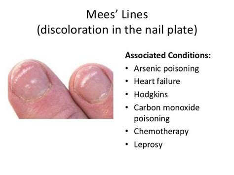 Fingernail And Toenail Abnormalities You Should Know