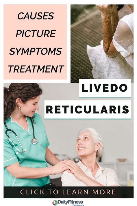 Livedo Reticularis Causes Picture Symptoms And Treatments Livedo