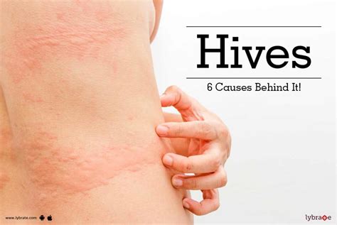 Hives Rash Or Urticuria 6 Cause Behind Skin Disorder By Kaya Skin Clinic Lybrate