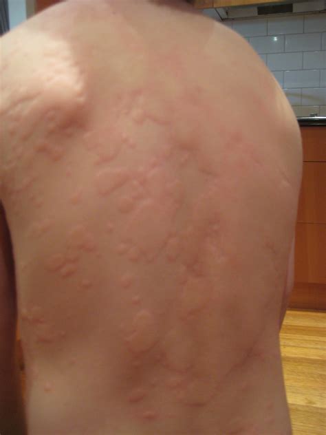 Urticaria Rash On The Skin Photograph By Dr P Marazzi