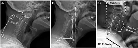 Parameters Defining Cervical Sagittal Alignment A Lordosis Angles B