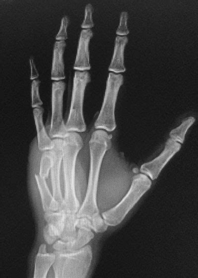 Boxers Fracture Houston Hand Surgeon Korsh Jafarnia Md