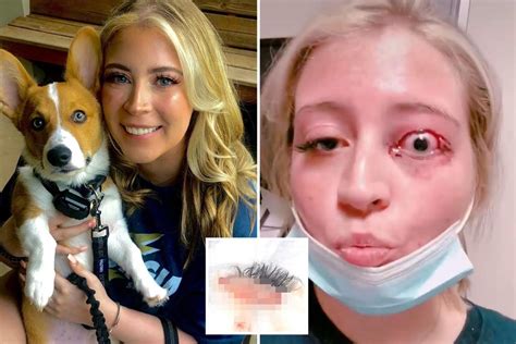 Birthday Girl Whose Eyelid Was Ripped Off By Chihuahua Blasts Lash