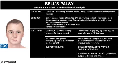 A stroke, on the other hand, is a medical emergency. Bell's Palsy and Burns | FOAMcast
