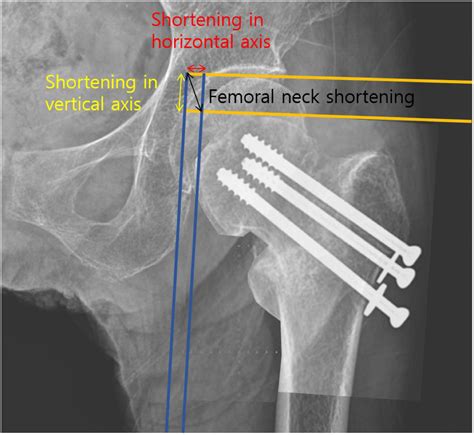 Posterior Fully Threaded Positioning Screw Prevents Femoral Neck