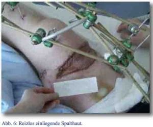 We did not find results for: BEHANDLUNGSVERLAUF EINER SUBTOTALEN OBERSCHENKELAMPUTATION ...