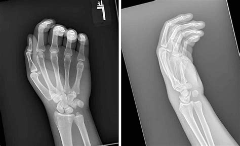 Cureus Isolated Volar Dislocation Of The Distal Radioulnar Joint Treated With Successful