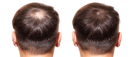 Alopecia Areata Overview Causes Symptoms And Treatment