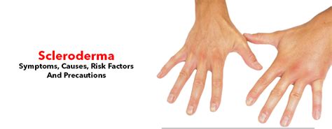 Scleroderma Symptoms Causes Risk Factors And Precautions Kayawell