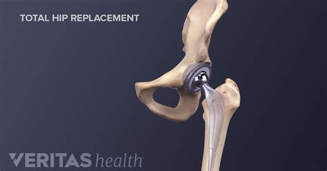 Top 8 How Long Is Total Hip Replacement Surgery In 2022 Thaiphuongthuy