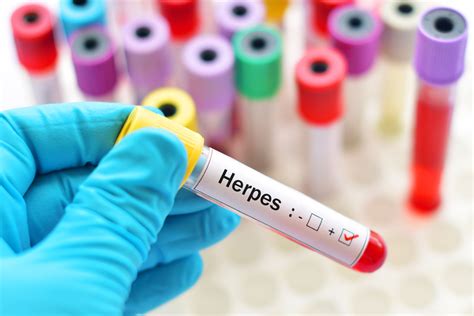 9 Signs Of Herpes You Cant Ignore Facty Health