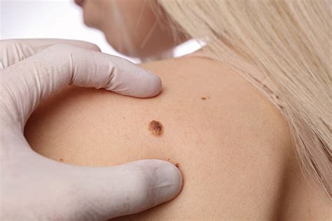 Body moles meaning in hindi and mole in nose and hand meaning. Mole Removal & Skin Lesions in York, PA | Dermatology ...