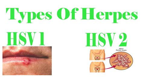 Types Of Herpes Herpes Simplex 1 Hsv 1 Herpes Simplex 2 Hsv 2