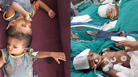 Conjoined Twins Surgery Jaga Out Of Icu Kalia Still Under Observation