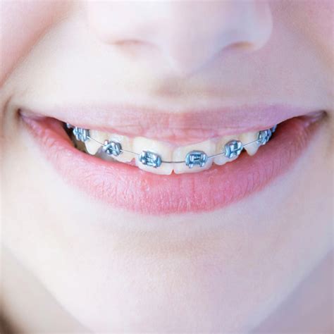 Metal Braces Braces Treatment In Launceston Scott Smith Orthodontics