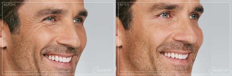 Best Botox For Men In Irvine Restore Your Appearance And Confidence