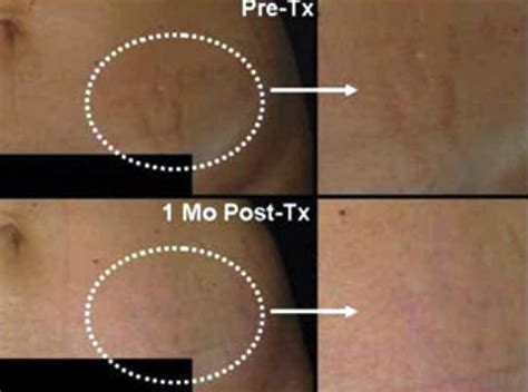 Laser Scar And Stretch Mark Removal