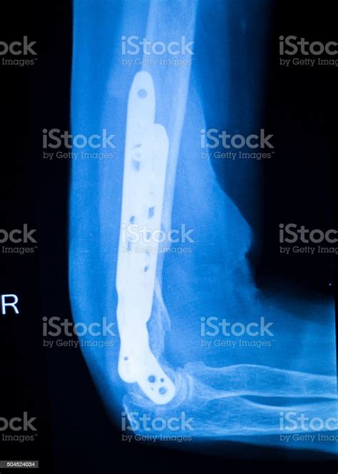 Surgical Implant Arm Elbow Xray Test Scan Stock Photo Download Image