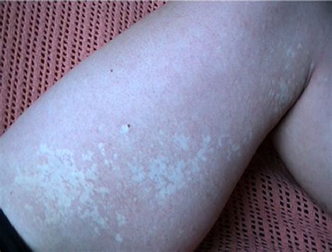 White Spots On Skin Medguidance