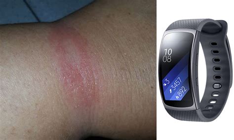 Samsung Smart Watch Caused Mysterious Burn Marks