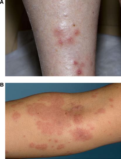 Types Of Skin Rash Caused By Molecularly Targeted Agents Skin Rash