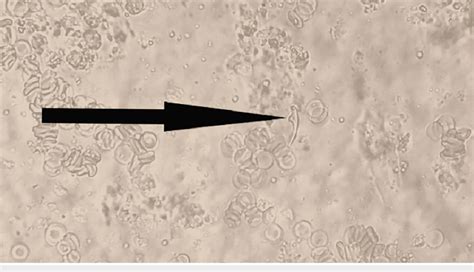 Free Hooklet From The Hydatid Cyst Fluid Observed By Microscopy 40x