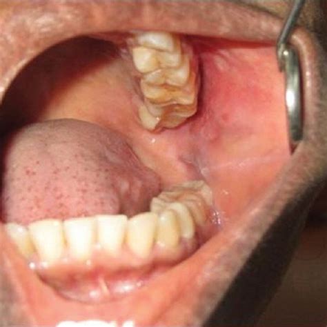 Swelling On The Left Buccal Mucosa Without Any Inflammatory Signs