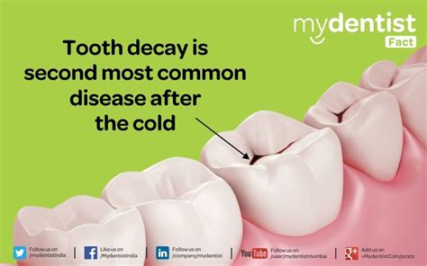 Tooth Decay Is Second Most Common Disease After The Cold Tooth Decay