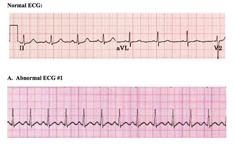 Solved For Each Of The Following Ecgs 1 Write What You