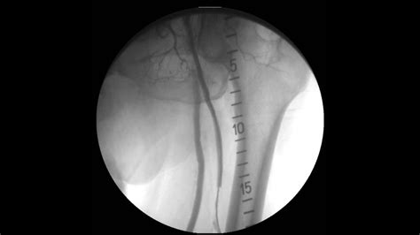 Angioplastia Con Stent De Arteria Femoral Profunda 5 Youtube