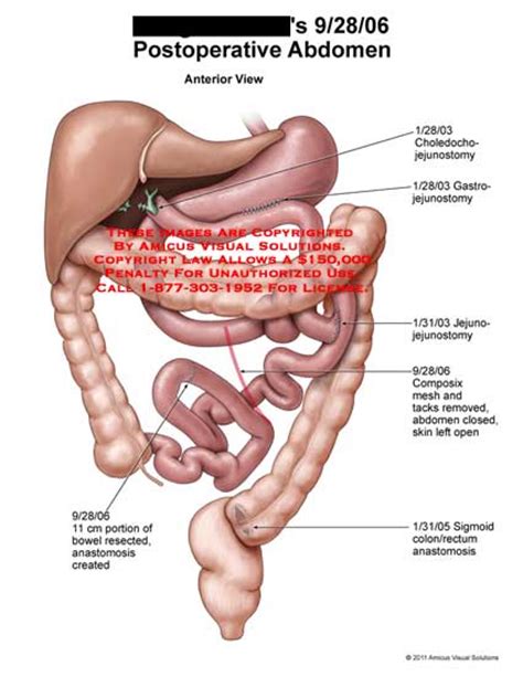 amicus illustration of amicus surgery abdomen bowel postoperative choledochojejunostomy