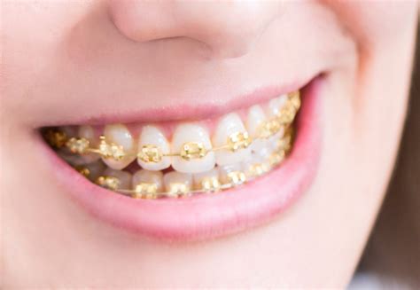 Gold Braces Los Angeles Et Beverly Hills 360 Orthodontie Stupidly Awesome But I Wouldnt