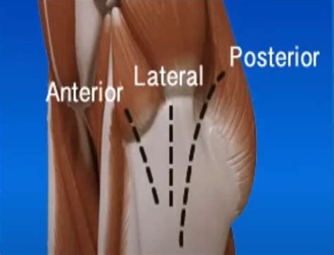 Anterior Vs Posterior Hip Replacement Young Hip Replacement