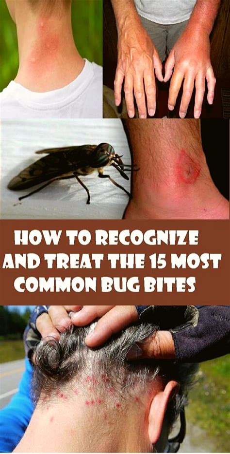 How To Recognize And Treat The 15 Most Common Bug Bites Bug
