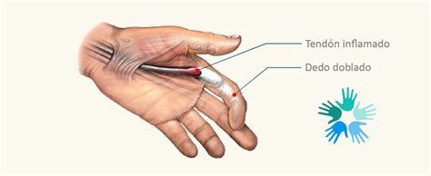 Dedo En Resorte O Tenosinovitis Estenosante