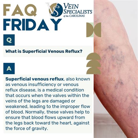 Faq Friday What Is Superficial Venous Reflux Vein Specialists Of