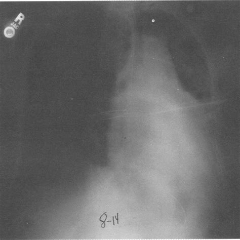 Chest Radiograph In Case 2 Showing Left Lower Lobe Collapse Due To