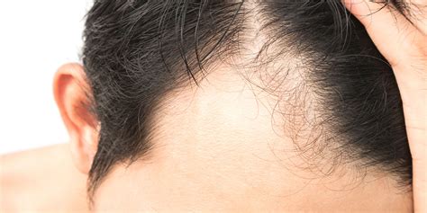 Alopecia Areata Hair Loss Treatment Norris Dermatology Portland Or