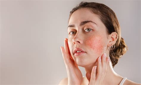 How To Reduce The Redness Of Face And Cheeks