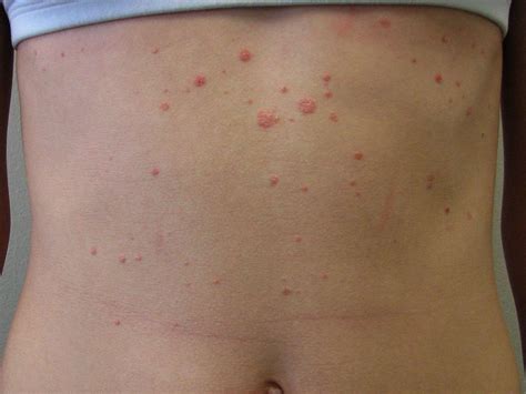 Mild Psoriasis Types Pictures And Treatment