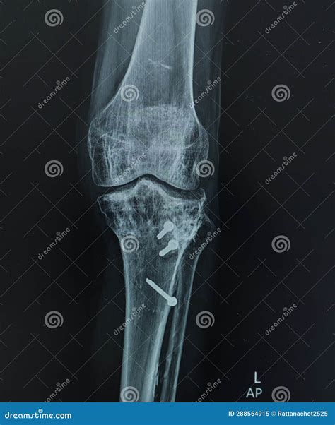 X Ray Left Knee Lateral View Avulsion Fracture Tibial Tubercle Post