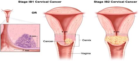 Early Squamous Cell Carcinoma Of The Cervix Implications For