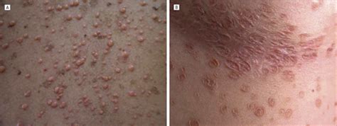 Adult Disseminated Primary Papular Xanthoma Treated With Doxycycline