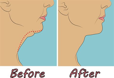How To Get Rid Of A Double Chin The Face Experts