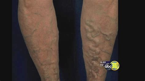 He New Face Of Varicose Veins Abc30 Fresno
